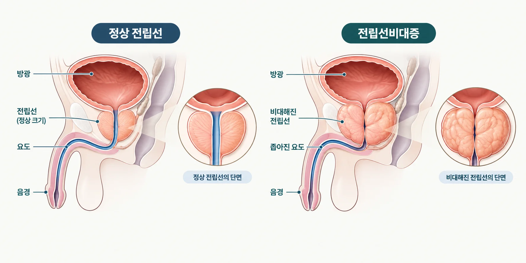 정상 전립선과 비대해진 전립선의 단면 비교 - 방광, 요도, 전립선 위치 설명 이미지